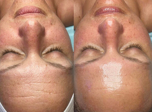 hydrofacial before and after 1 new