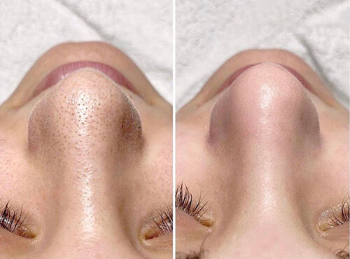 hydrofacial before and after 2 new