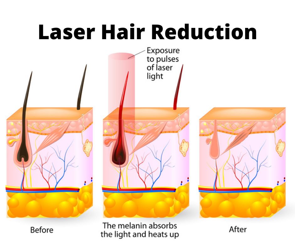 laser hair reduction graphic