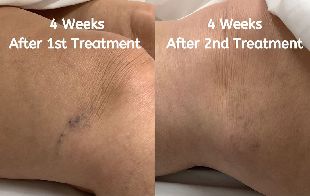 sclerotherapy graphic